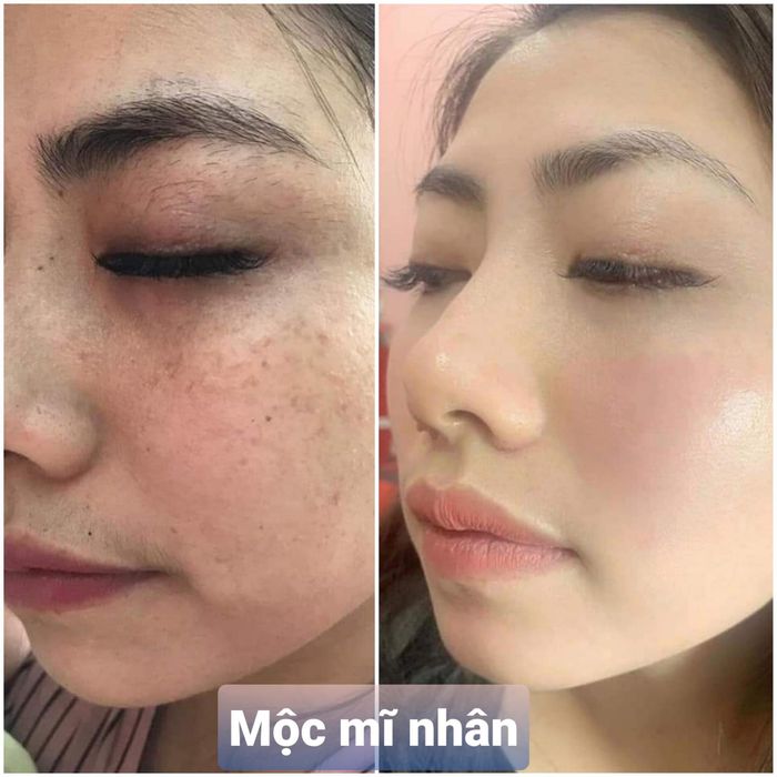 Hình ảnh liệu trình chăm sóc tại Lyna's Spa