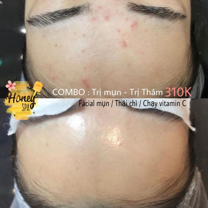 Hình ảnh trị liệu chuyên nghiệp tại The Honey's Spa