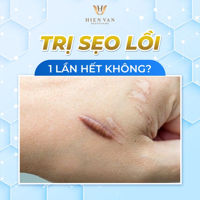 Quy trình trị sẹo lồi chuẩn y khoa tại HV CLINIC