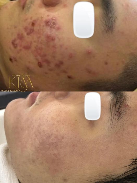 Hình ảnh quy trình trị liệu chuyên nghiệp tại Kim Beauty Spa
