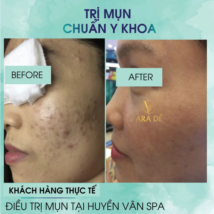Huyền Vân Home Spa - Bộ sưu tập hình ảnh trước và sau điều trị mụn ấn tượng