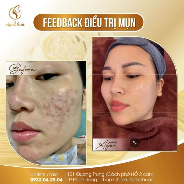 Hình ảnh trị liệu chuyên nghiệp tại April Spa & Clinic