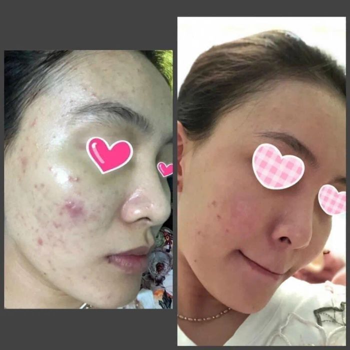 Hình ảnh quy trình trị liệu chuyên nghiệp tại Hạnh Phạm Beauty