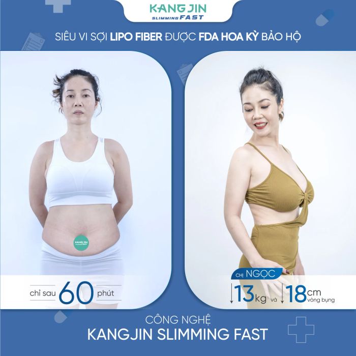 Hình ảnh thực tế quy trình giảm béo công nghệ cao tại KangJin