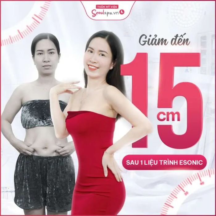 Hình ảnh thực tế quy trình giảm béo công nghệ cao tại SeoulSpa