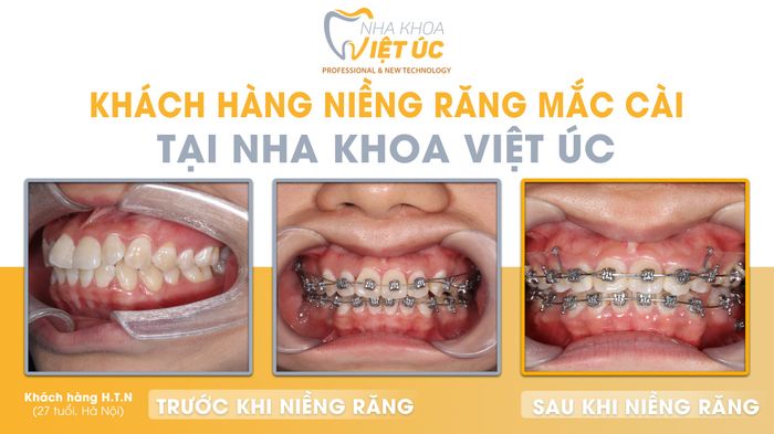 Hình ảnh thực tế về không gian hiện đại và trang thiết bị tiên tiến tại Nha Khoa Việt Úc