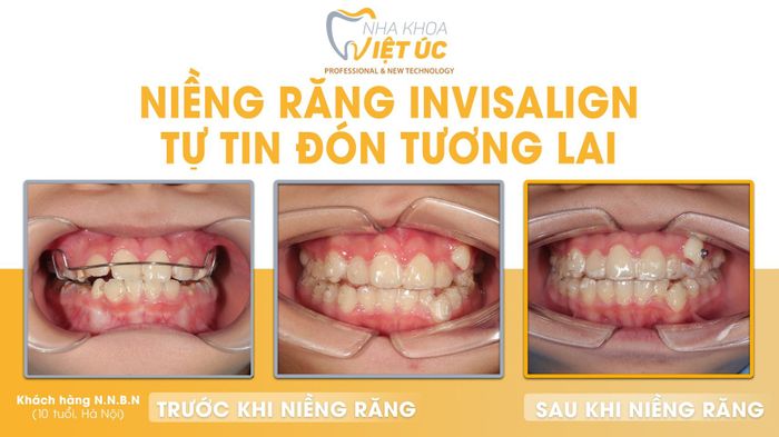 Hình ảnh thực tế về quy trình niềng răng chuyên nghiệp tại Nha Khoa Việt Úc