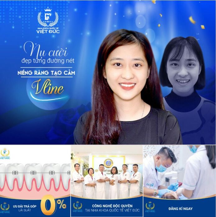 Hình ảnh minh họa quy trình niềng răng Invisalign chuyên nghiệp tại Nha Khoa Quốc Tế Việt Đức