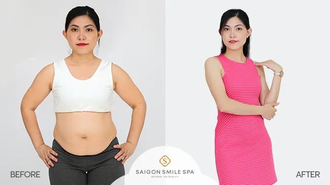 Hình ảnh thực tế quy trình giảm béo tại Saigon Smile Spa