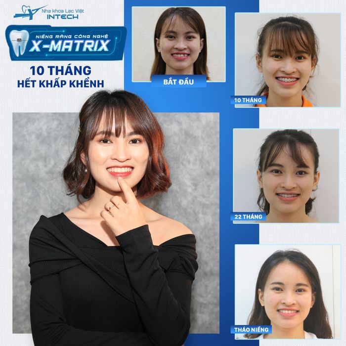 Hình ảnh thực tế tại Nha Khoa Lạc Việt Intech