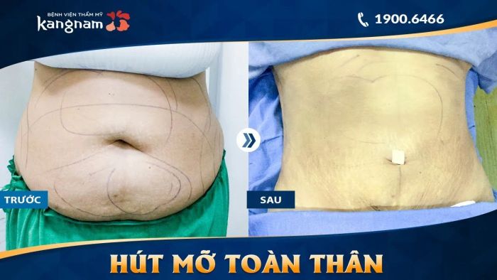 Hình ảnh thực tế quy trình giảm béo Vaser 4D tại Kangnam
