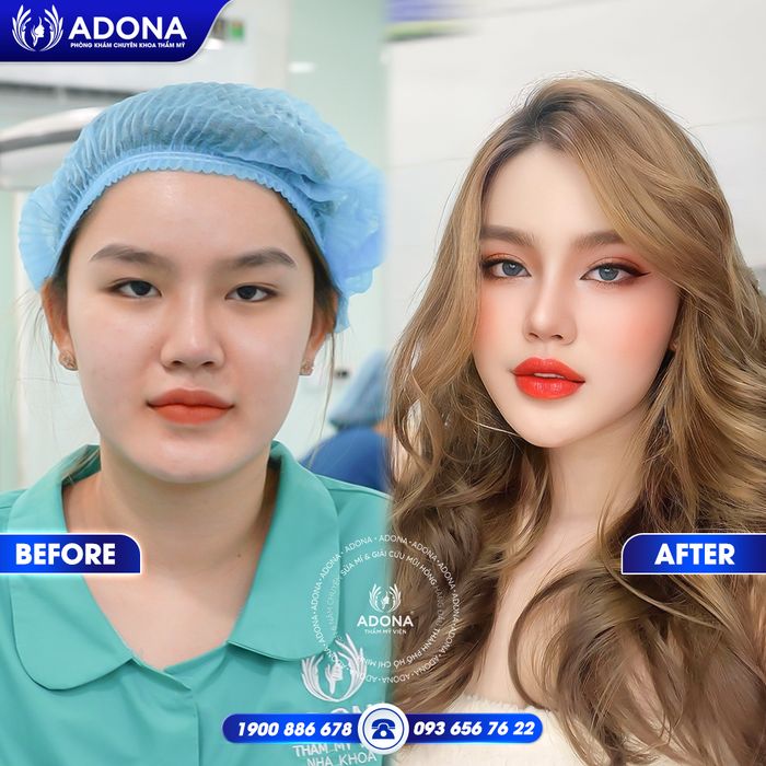 Quy trình thẩm mỹ chuẩn quốc tế tại Adona