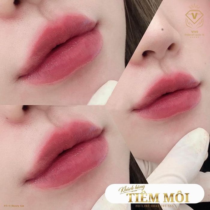 Hình ảnh quy trình thẩm mỹ chuẩn y khoa tại Thẩm Mỹ Viện Quốc Tế ViVi