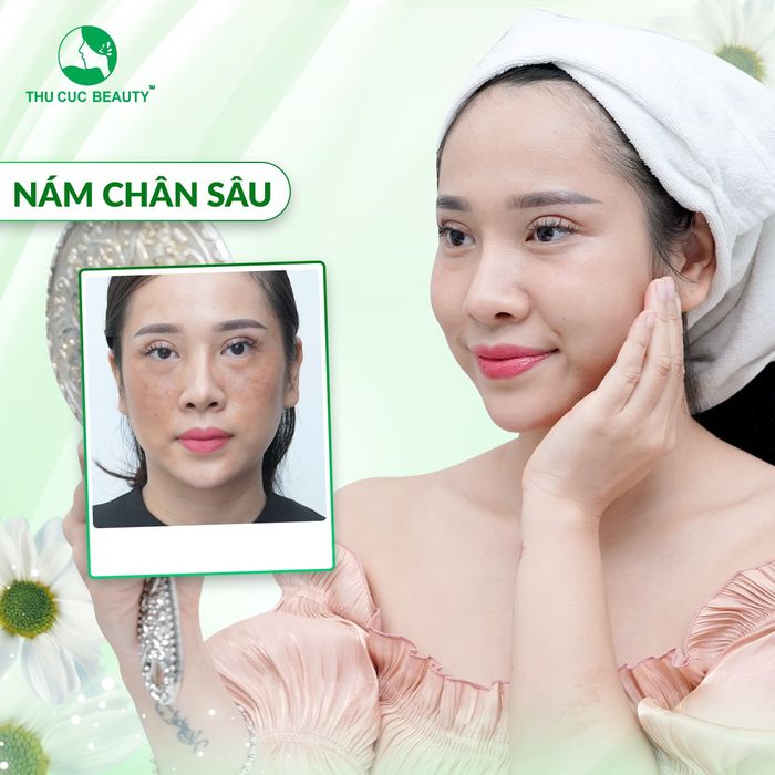 Hình ảnh quy trình điều trị da công nghệ cao tại Thu Cúc Clinics
