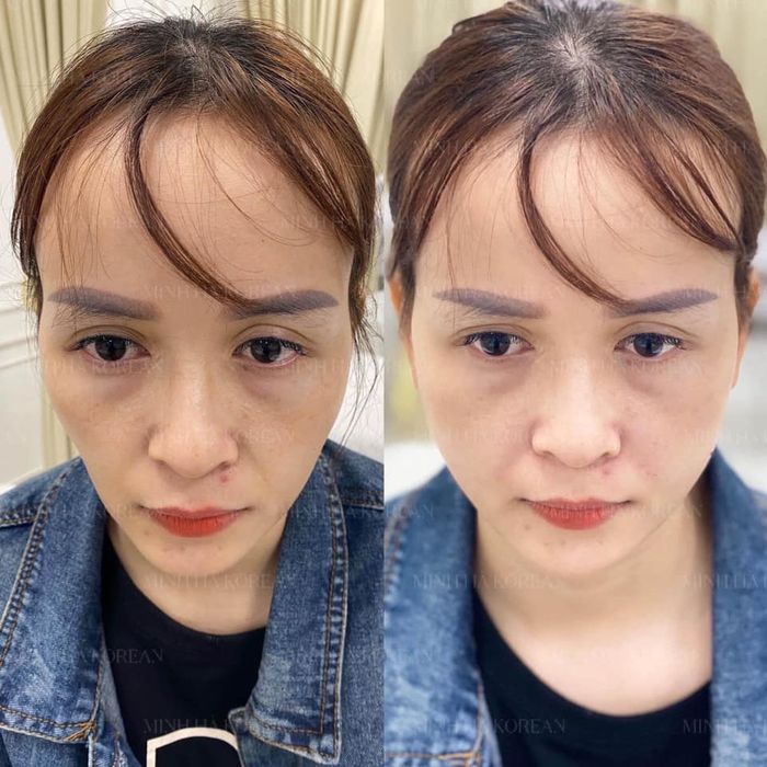 Phòng tiêm filler chuyên nghiệp tại Thủy Vũ Spa