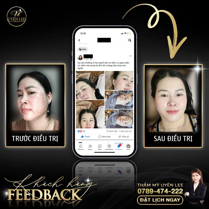 Hình ảnh quy trình thẩm mỹ chuẩn y khoa tại Uyên Lee