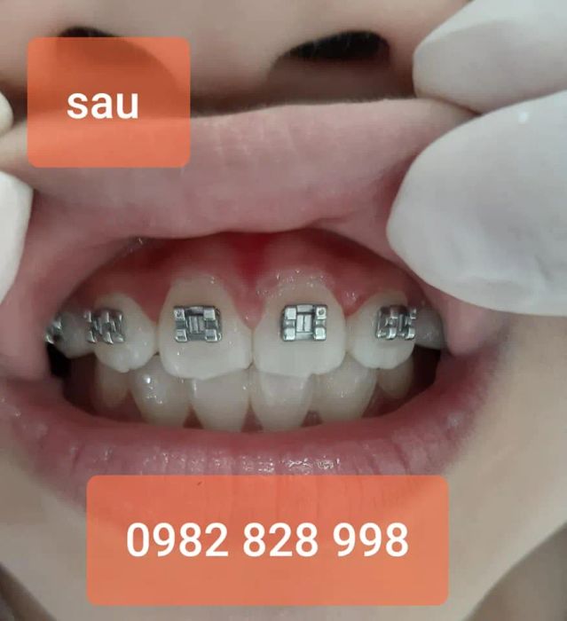 Hình ảnh thực tế về quy trình niềng răng chuyên nghiệp tại Nha Khoa Lạng Sơn