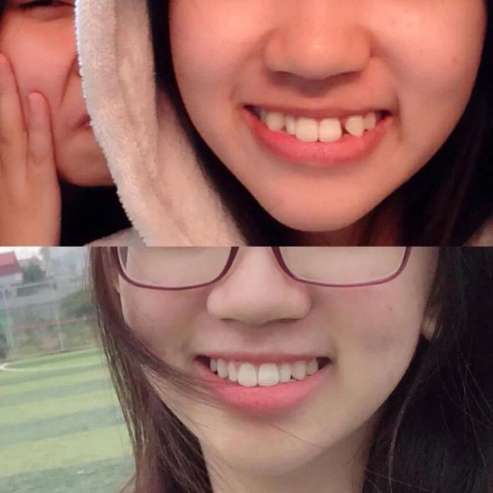 Hình ảnh quy trình niềng răng chuyên nghiệp tại Nha Khoa Cao Hảo