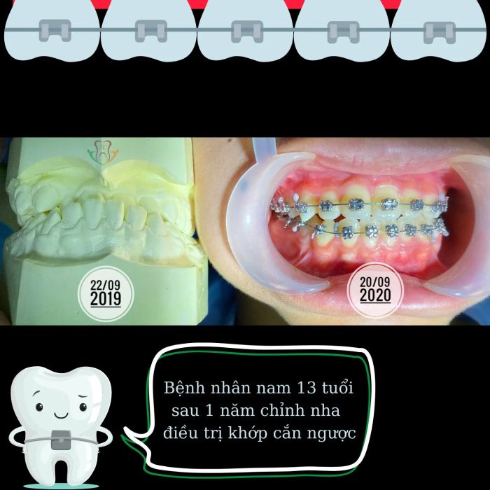 Quy trình niềng răng chuẩn y khoa tại Nha khoa Cao Chiến