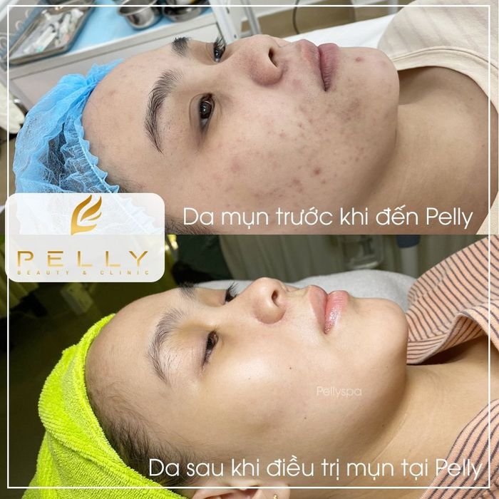 Hình ảnh quy trình trị liệu chuyên nghiệp tại Pelly Spa Trảng Bàng