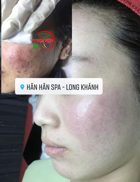 Hân Hân Spa - Hình ảnh 2: Quy trình trị liệu chuyên nghiệp với công nghệ hiện đại