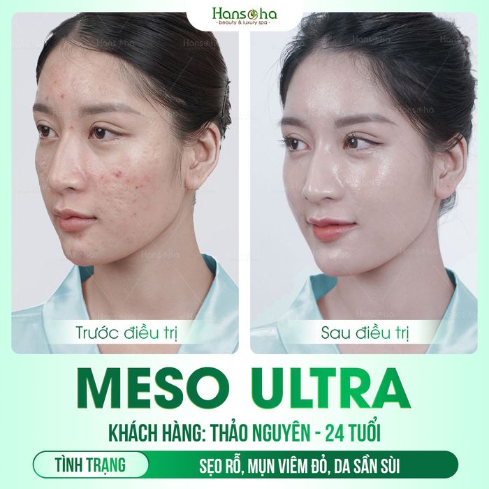 Hình ảnh thực tế về quy trình trị mụn chuyên nghiệp tại Viện Thẩm Mỹ Hansoha - Bắc Giang