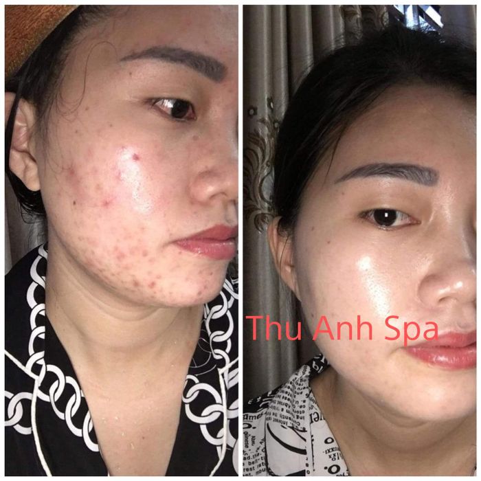 Hình ảnh thực tế về liệu trình trị mụn hiệu quả tại Thu Anh Spa & Clinic