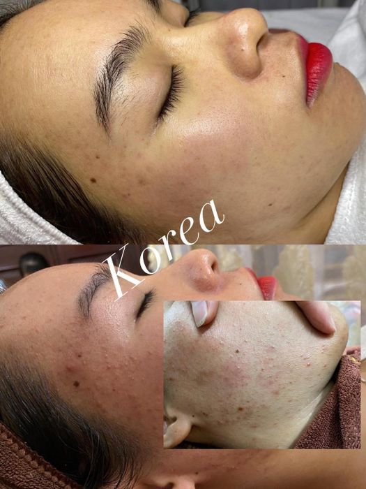 Hình ảnh thực tế quy trình trị mụn chuyên nghiệp tại Korea Spa & Clinic