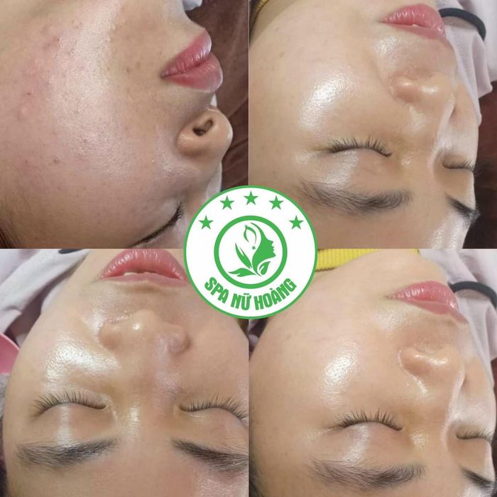 Quy trình trị liệu chuẩn y khoa tại Spa Nữ Hoàng