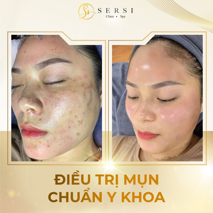 Quy trình trị mụn chuyên nghiệp tại SerSi Clinic & Spa - TP. Bắc Giang