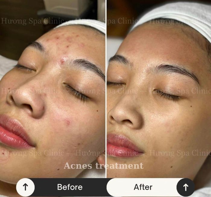 Ảnh 2 - Quy trình trị liệu da chuẩn y khoa tại Hương Spa & Clinic