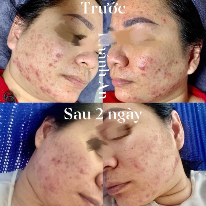 Anna Spa & Clinic - Hình ảnh 2: Quy trình chăm sóc da chuyên nghiệp với thiết bị tân tiến