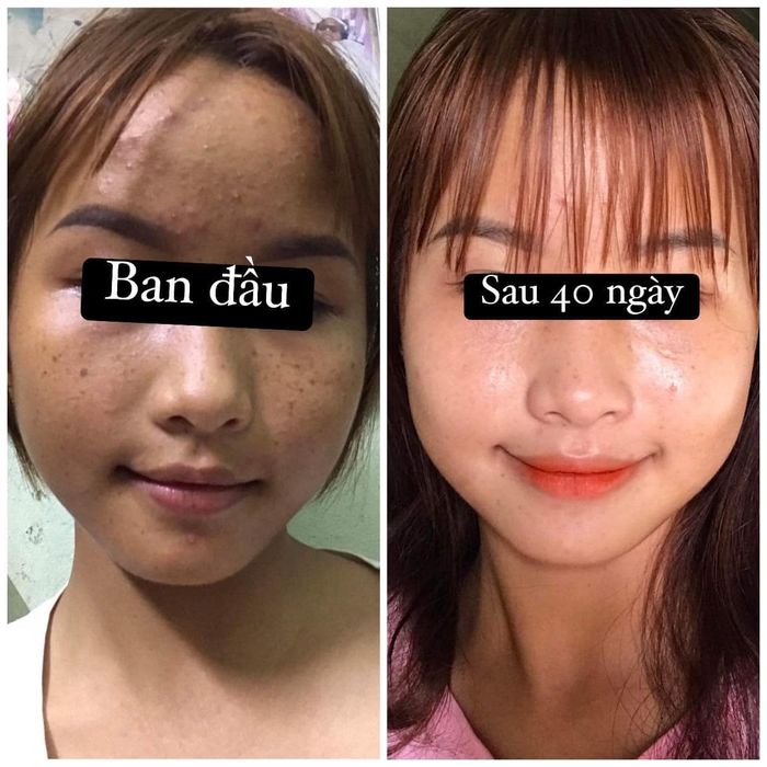 Hình ảnh thực tế về quy trình trị mụn tại Thẩm Mỹ Viện ALISA Bắc Giang