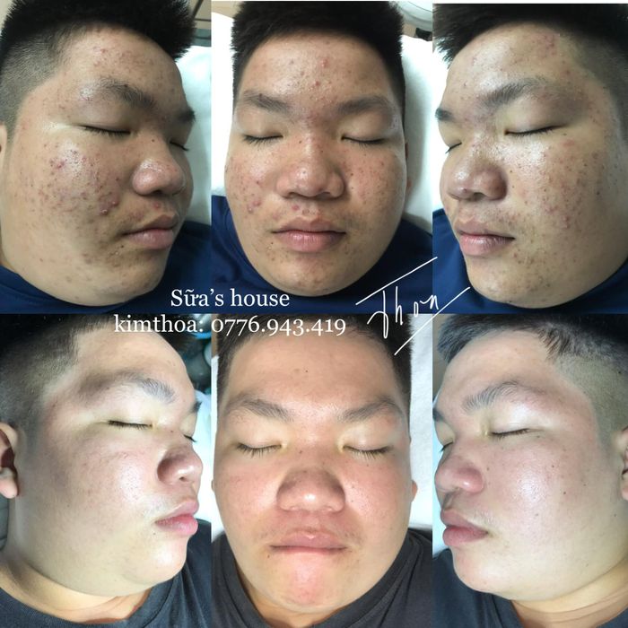 Hình ảnh thực tế về quy trình trị liệu tại SỮA'S HOUSE