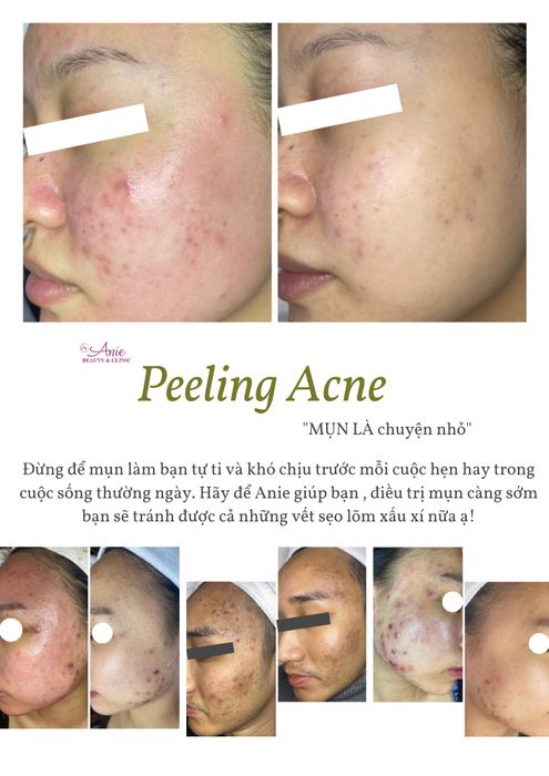 Quy trình peel da chuyên nghiệp tại Anie Beauty & Clinic Bắc Giang