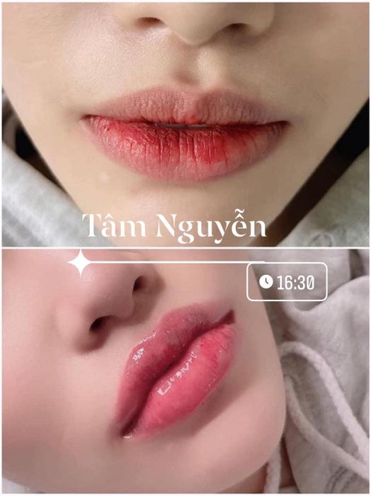 Kết quả thẩm mỹ ấn tượng tại Tâm Nguyễn Beauty