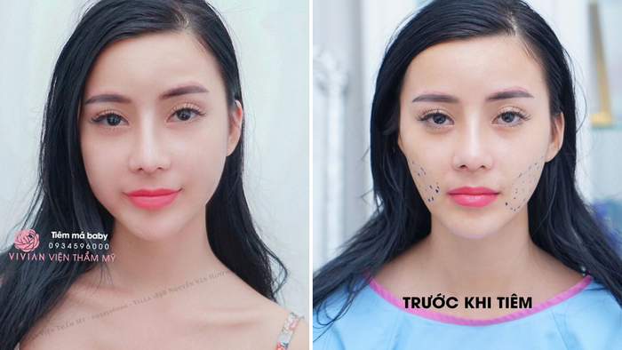 Kết quả thẩm mỹ ấn tượng tại Vivian Beauty