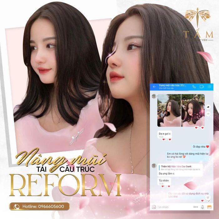 Nâng mũi - Thẩm Mỹ Viện Tấm - Hình ảnh 2