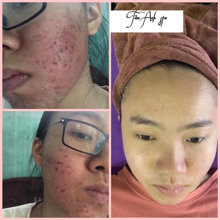 Quy trình trị mụn chuyên nghiệp tại Tâm Anh Spa