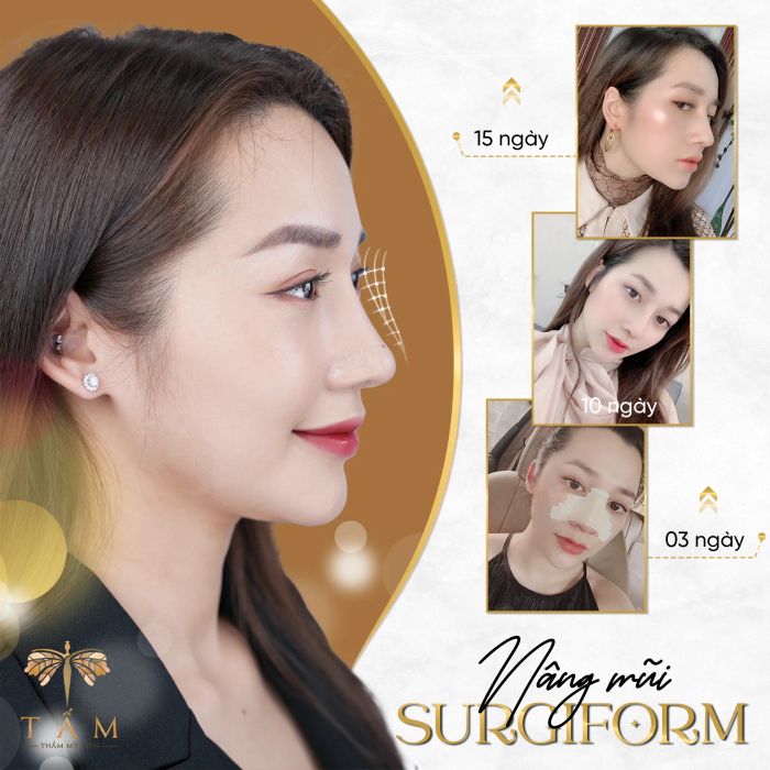 Nâng mũi - Thẩm Mỹ Viện Tấm - Hình ảnh 1