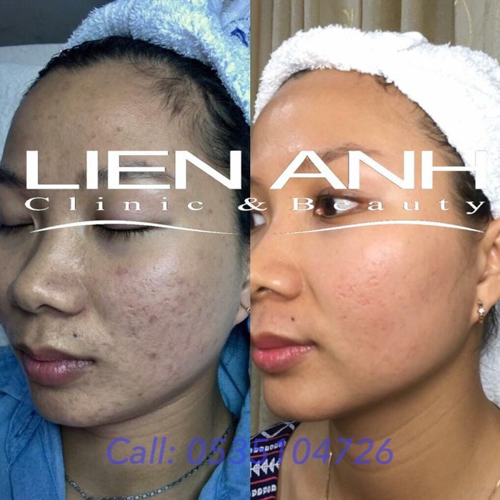 Hình ảnh thực tế về không gian trị liệu tại Viện Thẩm Mỹ Liên Anh