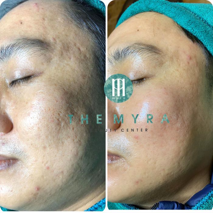Hình ảnh quy trình điều trị chuyên nghiệp tại The Myra Beauty Center