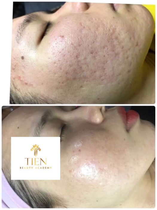 Hình ảnh quy trình trị liệu chuyên nghiệp tại Tiên Beauty & Academy