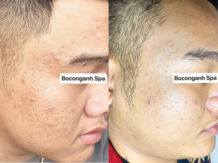 Hình ảnh thực tế quy trình trị sẹo tại Boconganh Spa