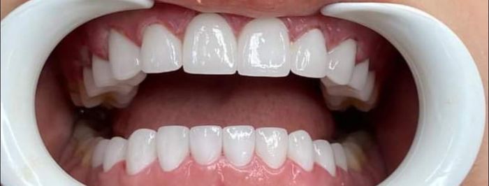 Trải nghiệm dịch vụ nha khoa cao cấp qua hình ảnh thực tế tại Phòng Khám Nha Khoa Việt Đức - Cao Bằng