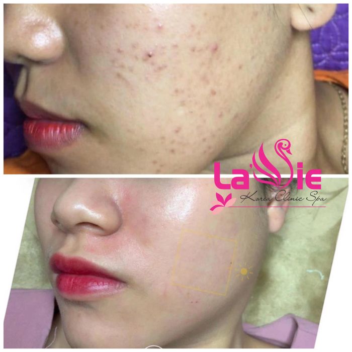 Phòng điều trị tiêu chuẩn tại Lavie Spa