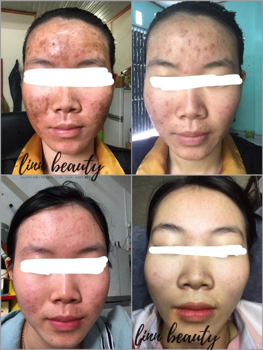 Phòng điều trị tiêu chuẩn tại Linn Spa Beauty