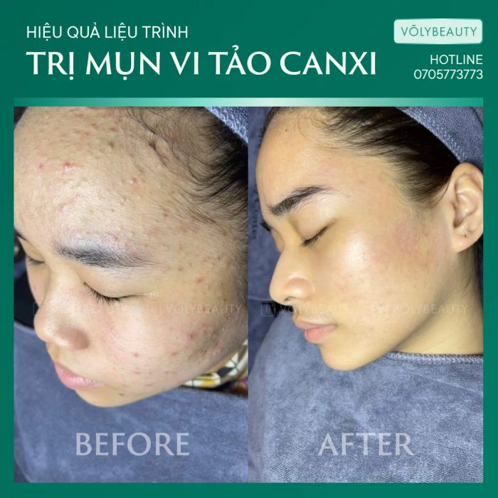 Hình ảnh quy trình trị liệu chuyên nghiệp tại Võ Ly Beauty Spa
