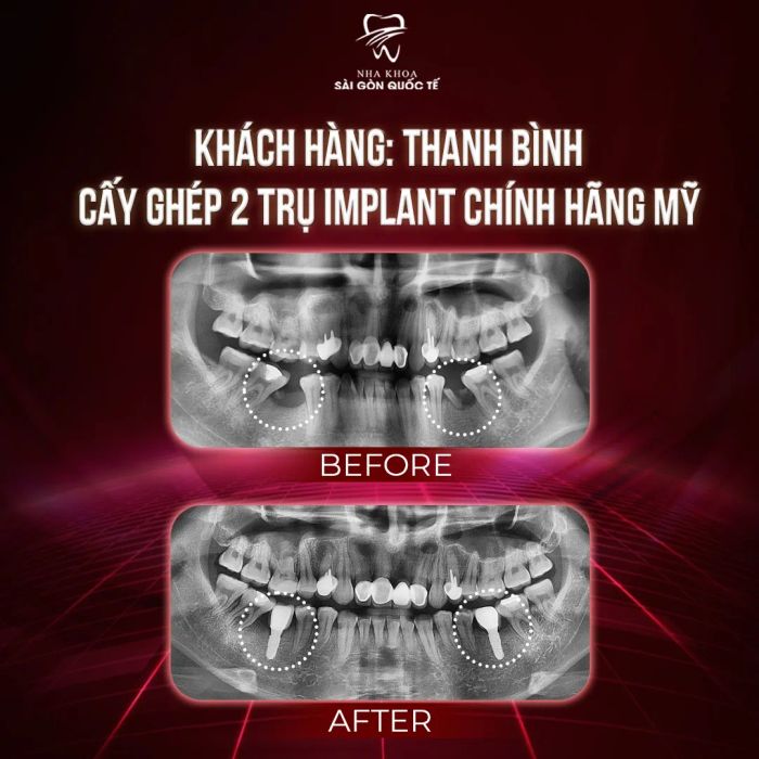 Hình ảnh Nha Khoa Quốc Tế Sài Gòn - Đơn vị dẫn đầu về cấy ghép implant tại Buôn Ma Thuột