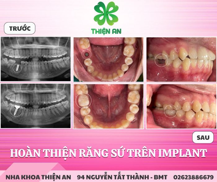 Hình ảnh phòng khám hiện đại tại Nha Khoa Thiện An - Địa chỉ vàng cho dịch vụ implant